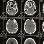 When Epilepsy Begins After 65?