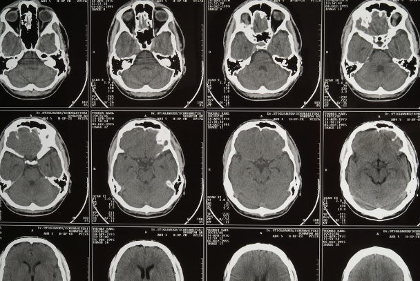 When Epilepsy Begins After 65?